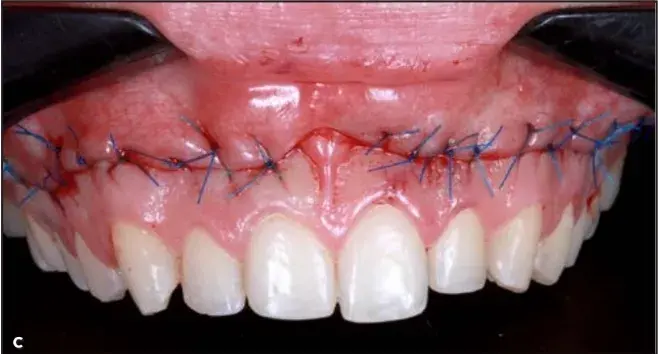 Lip Repositioning Surgery