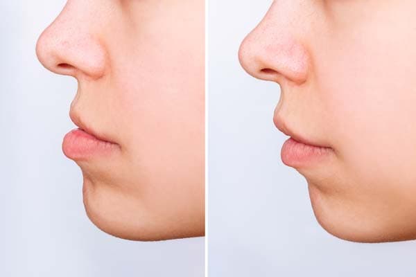 Jaw Surgery