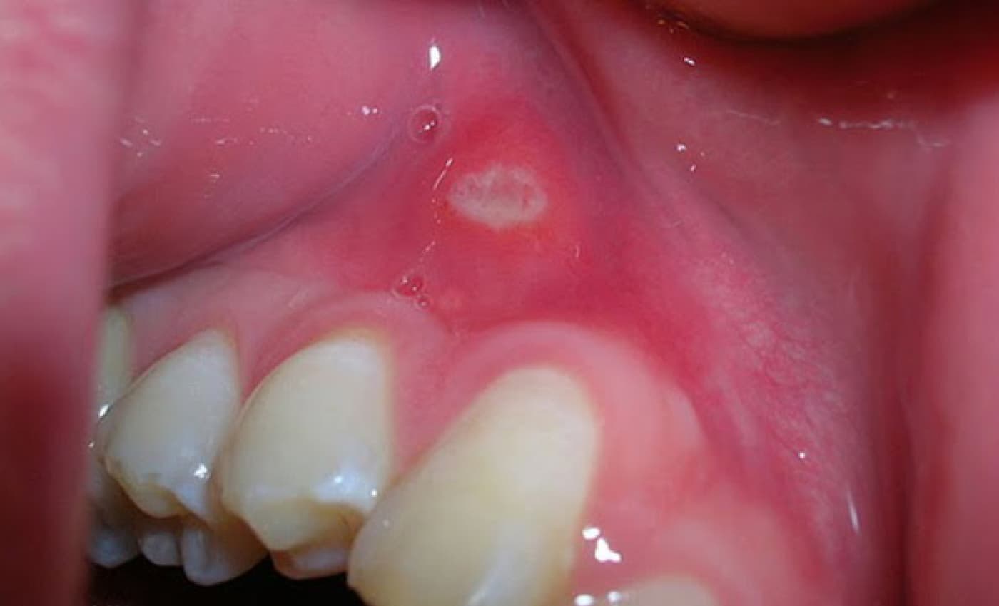 Oral Cancer Screening