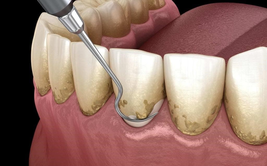 Periodontal Disease