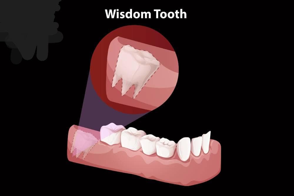 Wisdom Teeth Only Myth