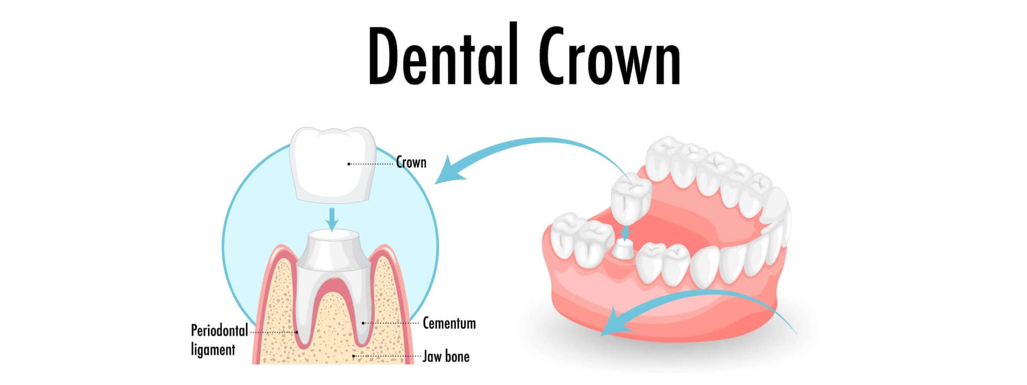 Dental Crowns
