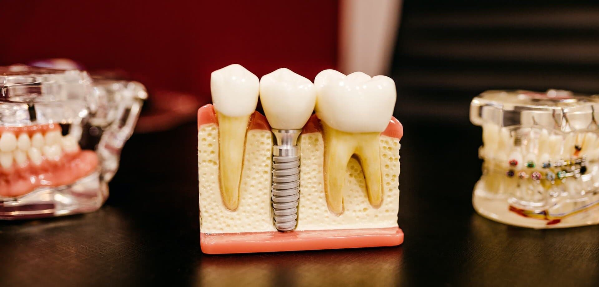 Dental Implants