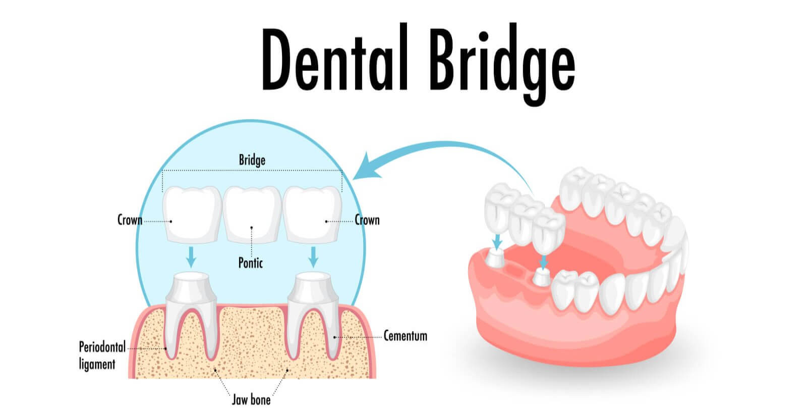 Dental Bridge Treatment in Gandhinagar
