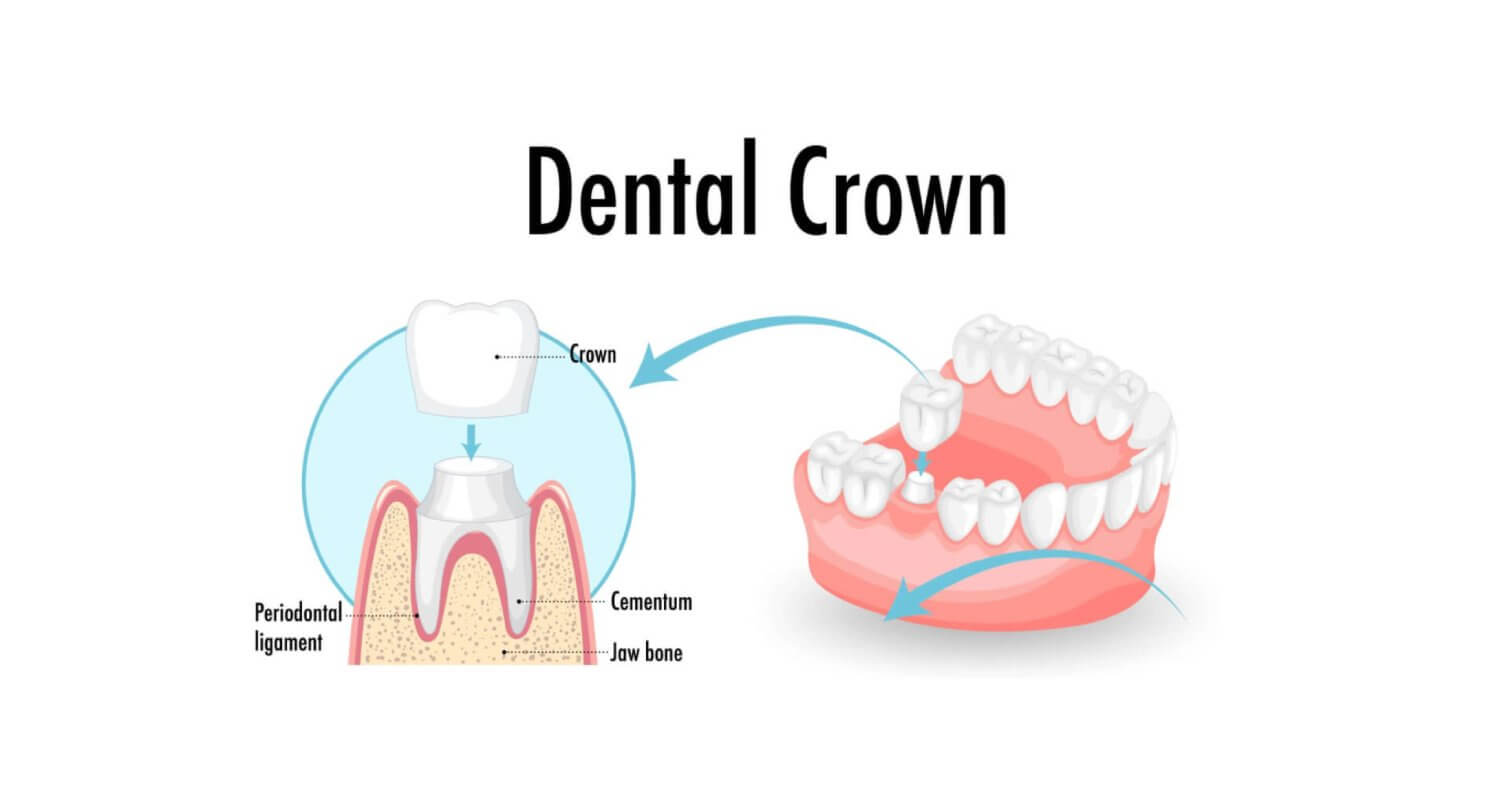 Dental Implants in Raysan Gandhinagar