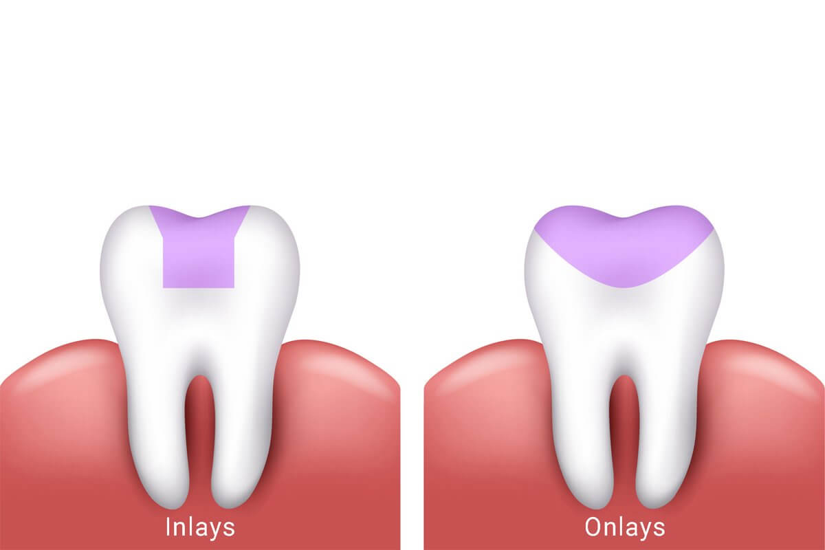 Root Canal Treatment in Raysan Gandhinagar