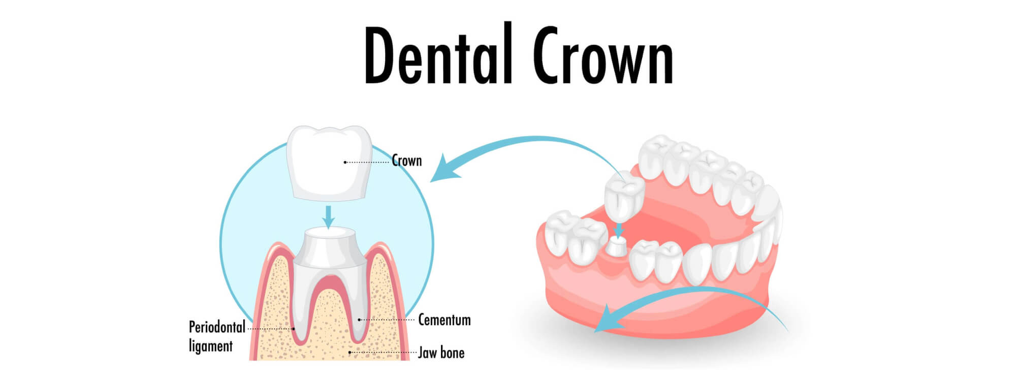 wisdom tooth removal in Raysan Gandhinagar